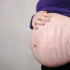 Brzuch z widocznymi, fioletowymi rozstępami, świadectwo zmian zachodzących w ciele.
