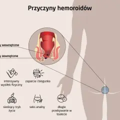 Ciąża i poród to częste przyczyny hemoroidów. Ilustracja pokazuje wewnętrzne i zewnętrzne hemoroidy oraz inne czynniki ryzyka.