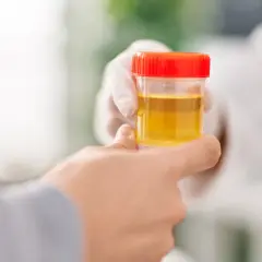 Rękawiczka medyczna podaje pojemnik z żółtym płynem, potencjalnie badanie na obecność bakterii w moczu w ciąży.