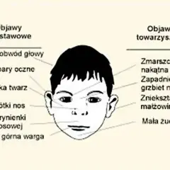 Ilustracja przedstawia twarz dziecka z zaznaczonymi objawami, które mogą wskazywać na zespół FAS.