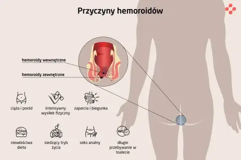 Ciąża i poród to częste przyczyny hemoroidów. Ilustracja pokazuje wewnętrzne i zewnętrzne hemoroidy oraz inne czynniki ryzyka.