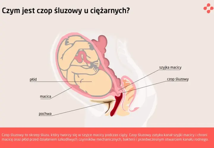Ilustracja przedstawia przekrój przez ciążową macicę z płodem. Widoczny jest czop śluzowy zamykający szyjkę macicy, chroniący płód.
