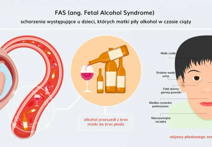 Ilustracja pokazuje płód w łonie matki, alkohol przechodzący do krwiobiegu płodu i cechy charakterystyczne dla zespołu FAS u noworodka.
