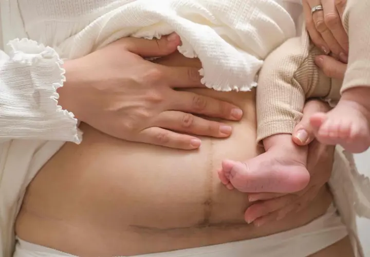 Brzuszek mamy z widocznymi zrostami po cc, otulony delikatnym materiałem, z maleńką stópką dziecka.