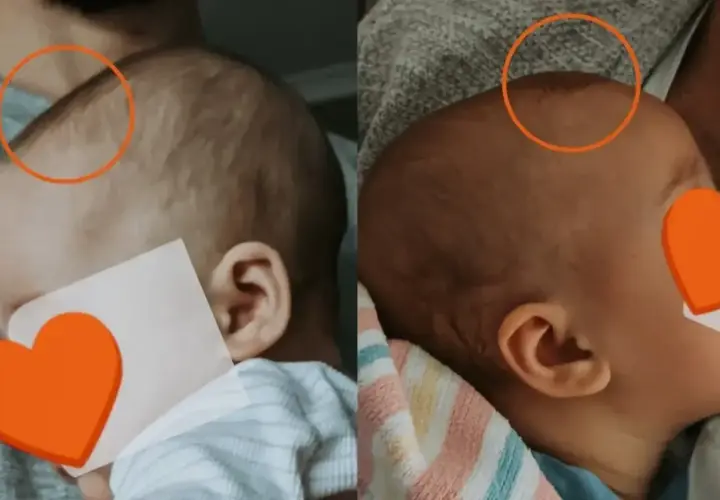 Dwa ujęcia główki niemowlaka. Na obu widoczne jest ciemiączko, zaznaczone pomarańczowym kółkiem.