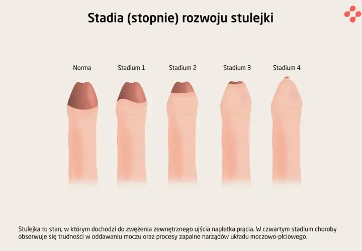 Ilustracja przedstawia stadia rozwoju stulejki, od normy do stadium 4, pokazując stopniowe zwężenie napletka.