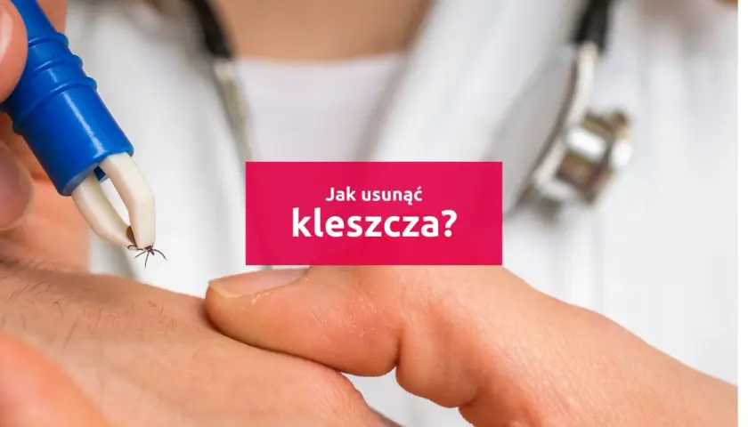 Pinceta delikatnie usuwa kleszcza ze skóry. Dowiedz się, jak wyciągnąć kleszcza bezpiecznie i skutecznie.