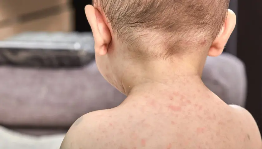 Skóra dziecka pokryta drobnymi, czerwonymi plamkami, które mogą być objawem trzydniówki.