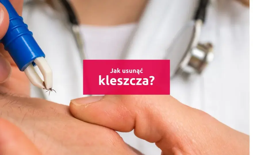 Jak usunąć kleszcza u dziecka? Bez paniki i błędów!