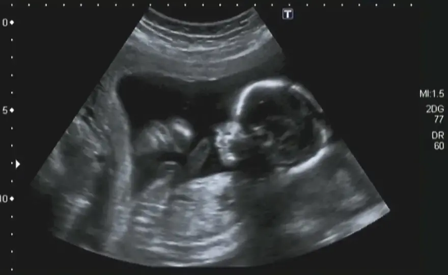 Zespół Edwardsa - trisomia 18, objawy i diagnoza