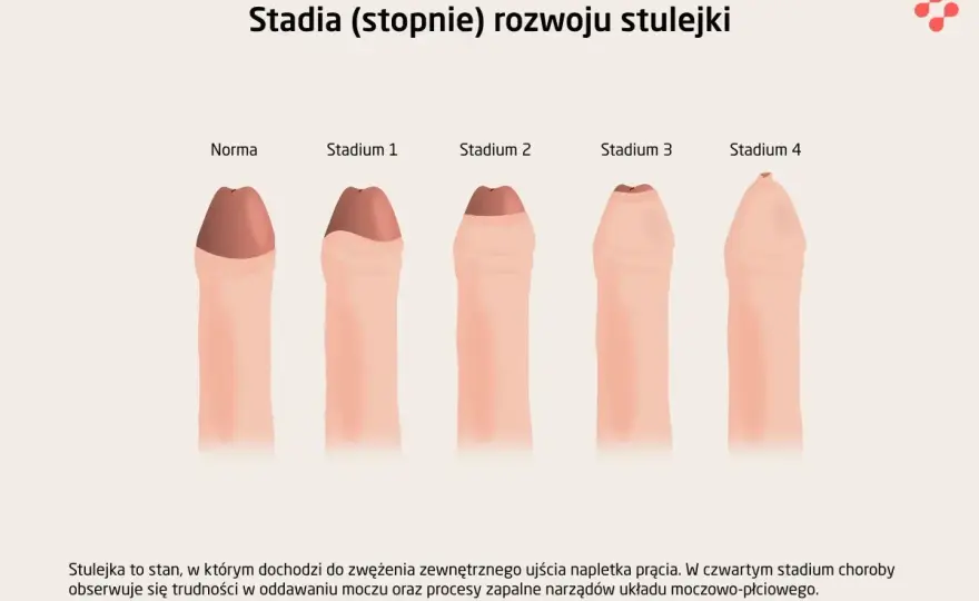 Stulejka u noworodka - kiedy jest normą, a kiedy wymaga pomocy?