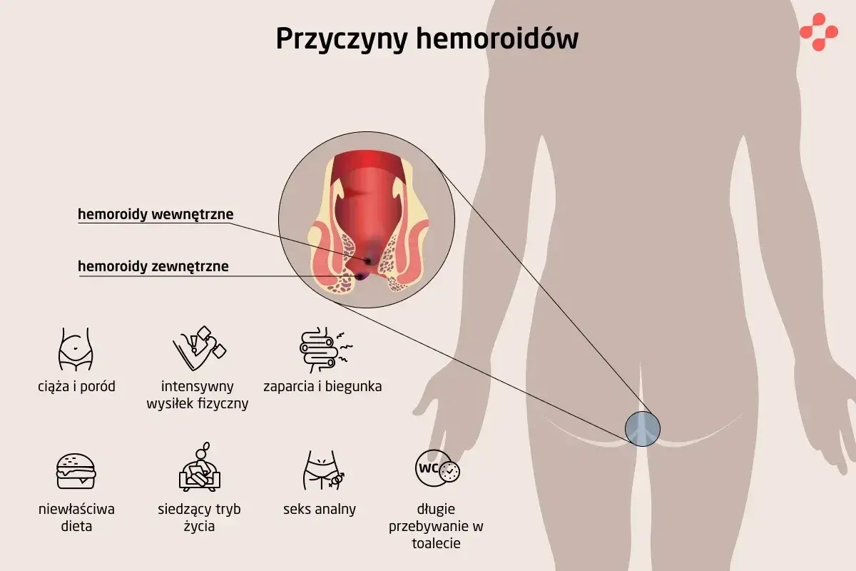 Ciąża i poród to częste przyczyny hemoroidów. Ilustracja pokazuje wewnętrzne i zewnętrzne hemoroidy oraz inne czynniki ryzyka.