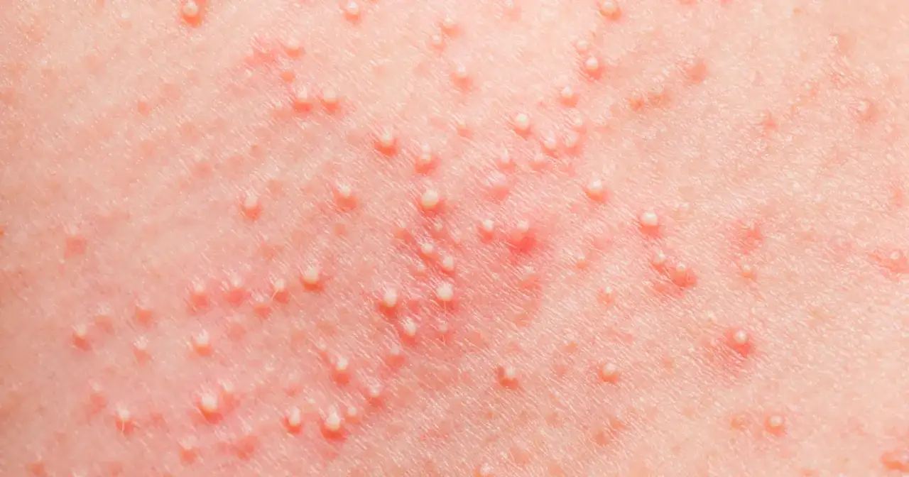 Delikatna skóra niemowlaka z licznymi białymi krostkami i zaczerwienieniem, charakterystyczne potówki u niemowlaka.