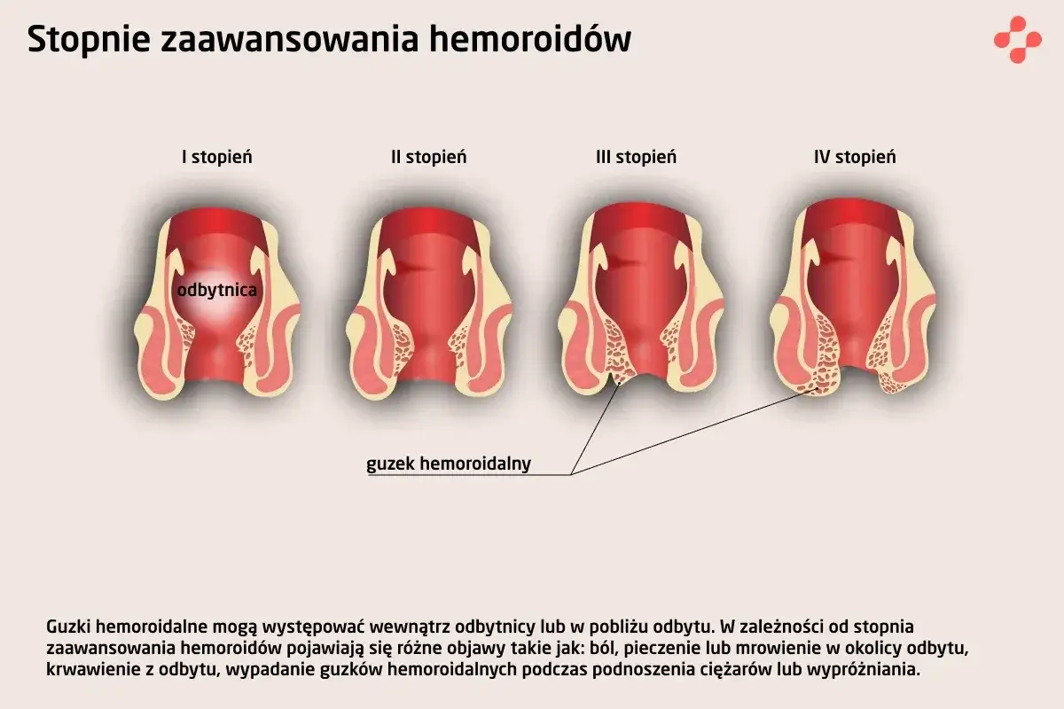 Ilustracja przedstawia stopnie zaawansowania hemoroidów, które mogą pojawić się po porodzie. Widoczne są zmiany w obrębie odbytu.
