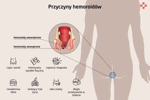 Ciąża i poród to częste przyczyny hemoroidów. Ilustracja pokazuje wewnętrzne i zewnętrzne hemoroidy oraz inne czynniki ryzyka.