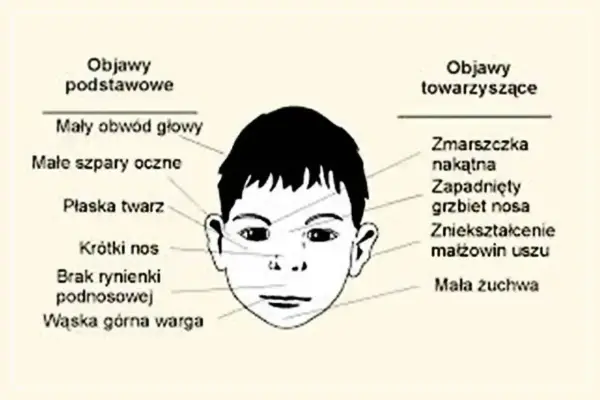 Ilustracja przedstawia twarz dziecka z zaznaczonymi objawami, które mogą wskazywać na zespół FAS.