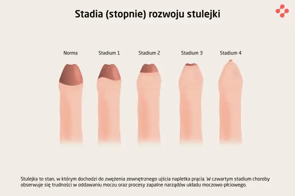 Ilustracja przedstawia stadia rozwoju stulejki, od normy do stadium 4, pokazując stopniowe zwężenie napletka.